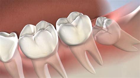 Sedation Options for Wisdom Teeth Removal - Wisdom Dental Emergency