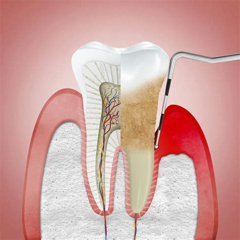 Periodontitis Treatment | Corsodyl