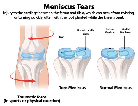 Meniscus Tears: Can You Recover Without Surgery? | Dr Bryan