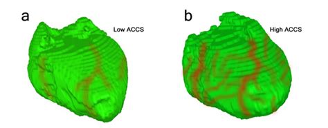 Alavi–Carlsen Calcification Score (ACCS): A Simple Measure of Global ...