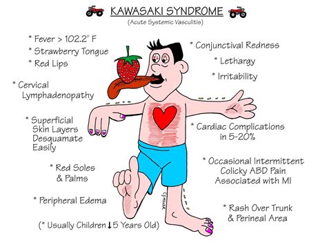 Nursing Mnemonics: Kawasaki Syndrome - StudyPK