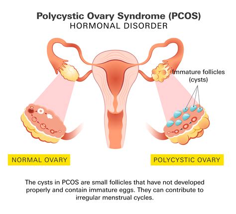 Polycystic Ovary