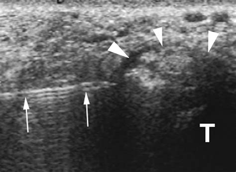 Posterior Ankle Impingement in Professional Soccer Players ...