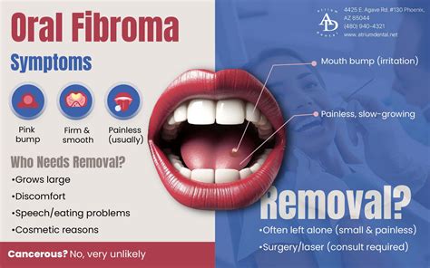 Removal Of Fibroma In The Mouth Or Lip Melbourne Dentist Oral Fibroma