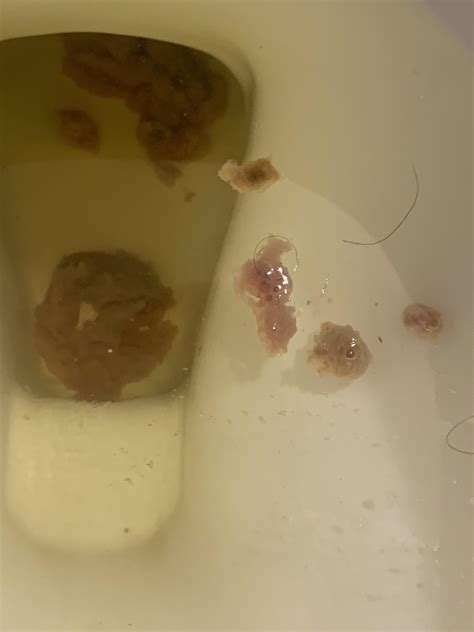 Black Specks In Stool Yeast Die Off at Phillip Hayes blog