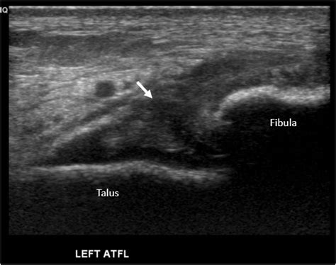 Common foot and ankle disorders in pregnancy: the role of diagnostic ...