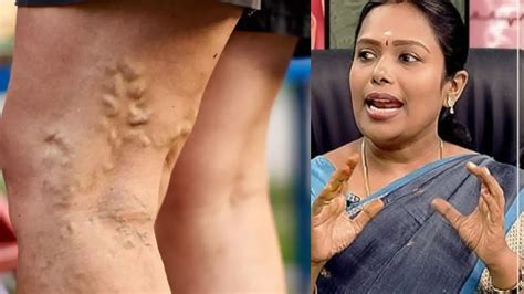 Effective Home Remedies For Varicose Veins : வெரிகோஸ் வெயின் குணமாக ...