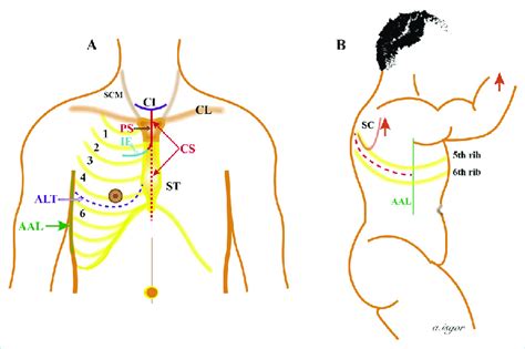 Image result for Open Chest Thoracotomy