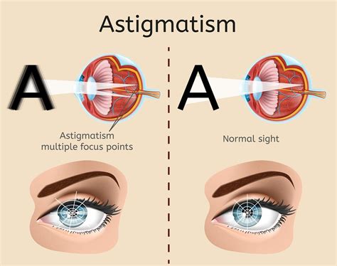 How To Improve Astigmatism » Foundationpattern