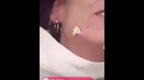 Image result for Abscessed Cysts Exploding