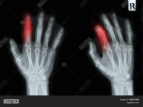 Xray Right Hand Show Image & Photo (Free Trial) | Bigstock