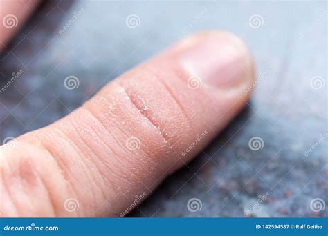 Dry Cracked Skin on the Finger of a Male Hand Stock Image - Image of healthcare, health: 142594587