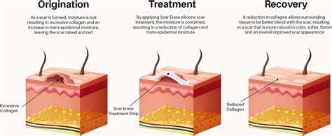 Scar Erase Silicone Scar Sheet Treatment - Soften & Flatten Surgery ...