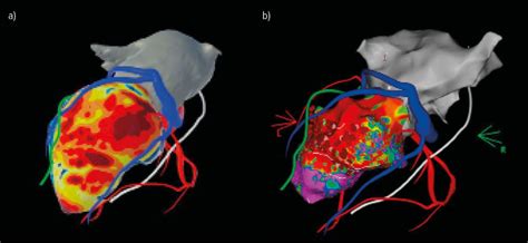 Radiofrequenzablation ventrikulärer Arrhythmien - Kardiologie ...