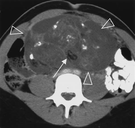 Ovarian Teratomas: Tumor Types and Imaging Characteristics | RadioGraphics