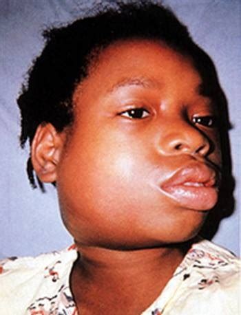 Franca - Blog - Dealing with MUMPS? Don't panic