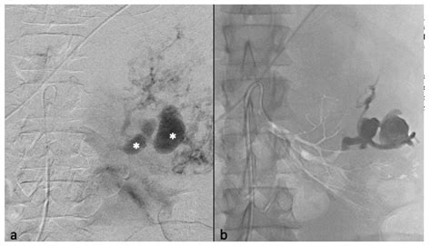 Safety, Efficacy and Mid-Term Outcome for Transarterial Embolization (TAE) of Renal ...