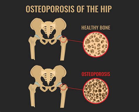 Educate Yourself On World Osteoporosis Day | Herzindagi