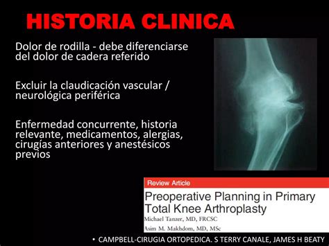 Protesis de rodilla | PPTX