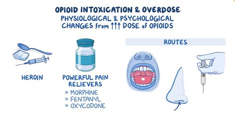 Opioid intoxication and overdose: Clinical sciences - Osmosis Video Library
