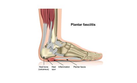 Plantar Fasciitis 的图像结果