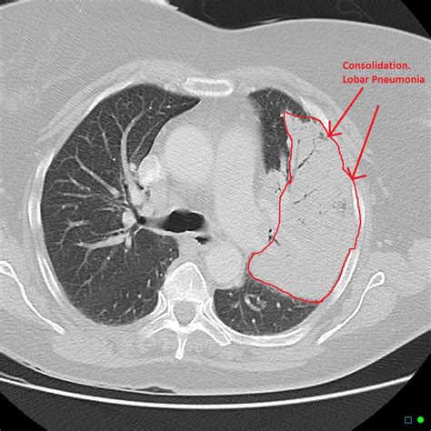 Chest X Ray Vs Ct Scan Pneumonia at Frederick Rosado blog