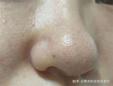 为什么鼻子容易长黑头 - 聚尚|Fetchion|广州云域数字科技有限公司