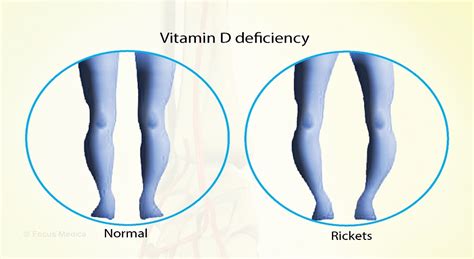Rickets Disease - Causes, Symptoms, Diagnosis, Treatment & Prevention