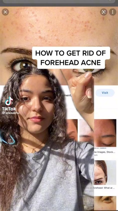 Have blind pimples here s how to treat pimples – Artofit