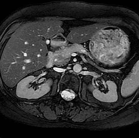 Pancreatic adenocarcinoma - Body MR Radiology Case Studies - CTisus CT ...