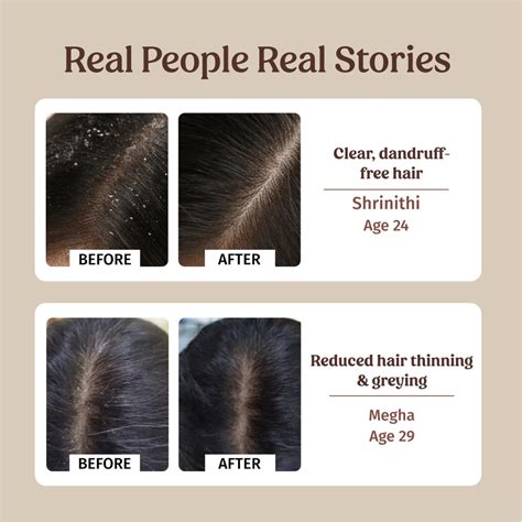 Anti-dandruff Combo Products Online - Vilvah