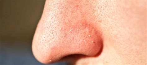Clogged pores on nose: Meaning, causes, treatment | The Pink Foundry