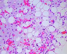 liposarcoma 的图像结果