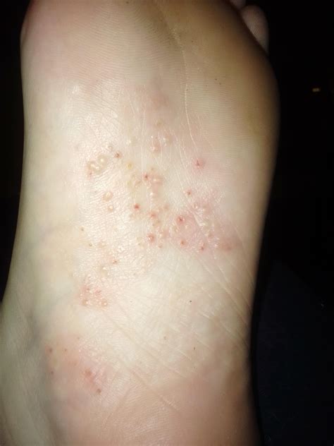 White bumps on the bottom of my feet? : r/medical_advice