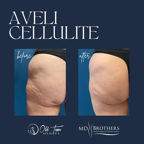 Aveli Cellulite Treatment Chicago & Lincoln Park IL