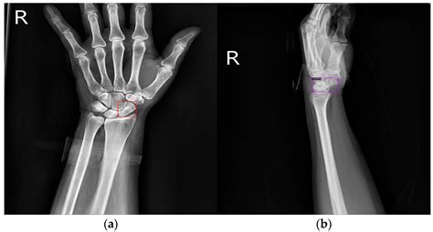 The Detection and Classification of Scaphoid Fractures in Radiograph by Using a Convolutional ...