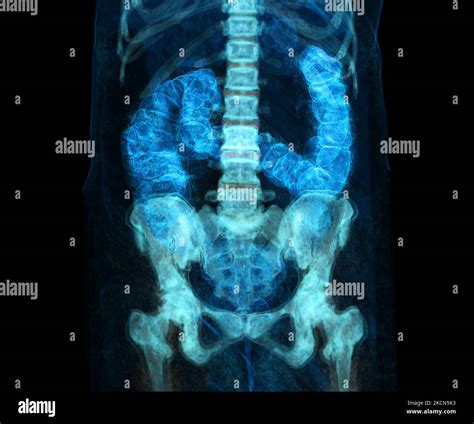 CT Colonography ou CT Scan of Colon 3D image de rendu pour le dépistage du cancer colorectal ...