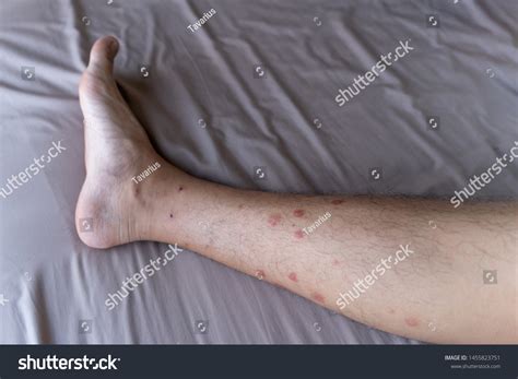 Mosquito Bites On Legs