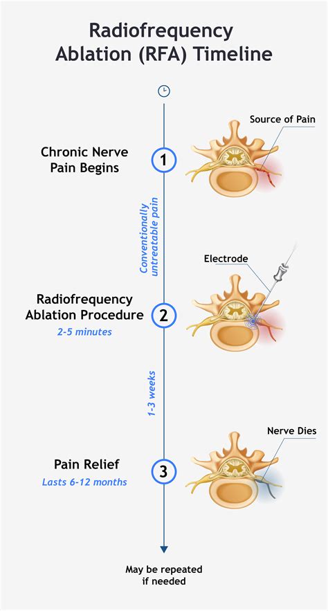 How Long Does it Take for Nerves to Die After Radiofrequency Ablation? | Advanced Spine and Pain