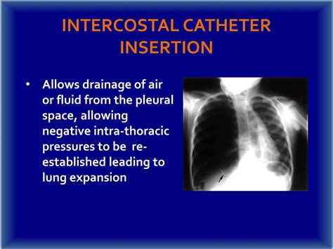Intercostal catheter insertion | PPTX