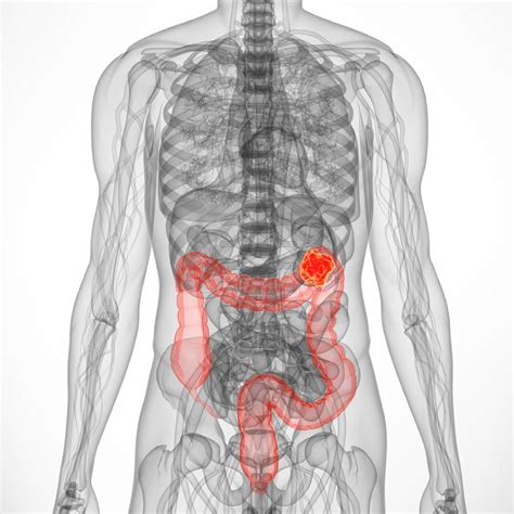 Stories Archive - Page 16 of 21 - Bowel Cancer Australia