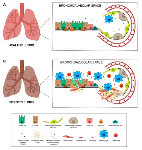 The Role of Mesenchymal Stem Cells in Radiation-Induced Lung Fibrosis