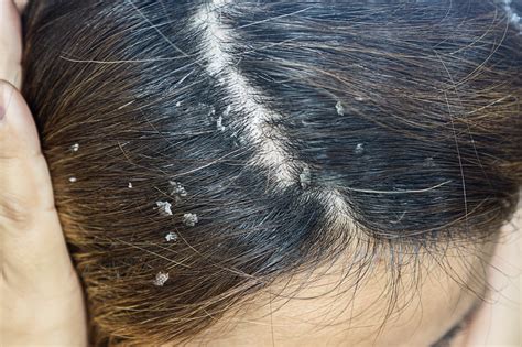 Is Dandruff Spreadable