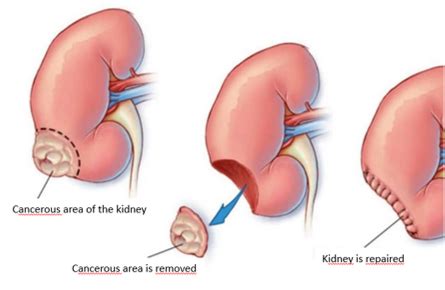 Image result for Robotic Nephrectomy Extraction Incision