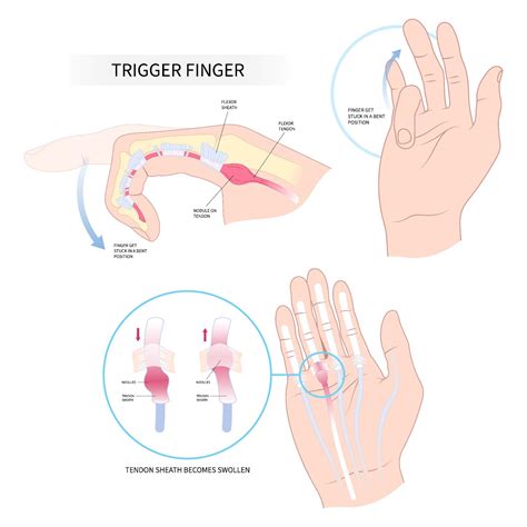 Trigger Finger