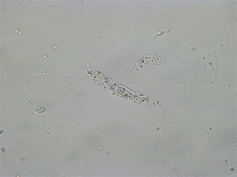 Wbc Casts In Urine