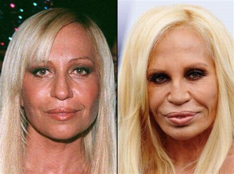 Bildergebnis für celebrities+that+have+plastic+surgery