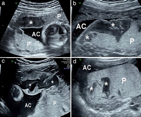 Placental lakes vs lacunae: spot the differences - Jauniaux - 2024 - Ultrasound in Obstetrics ...