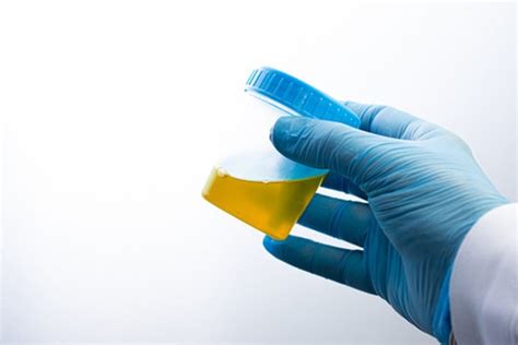 Urine Test - Nurseweb