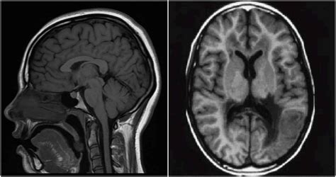 Normal Mri Brain Tractography Wikipedia
